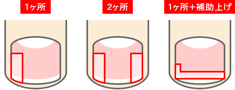 補正具の取付ヶ所